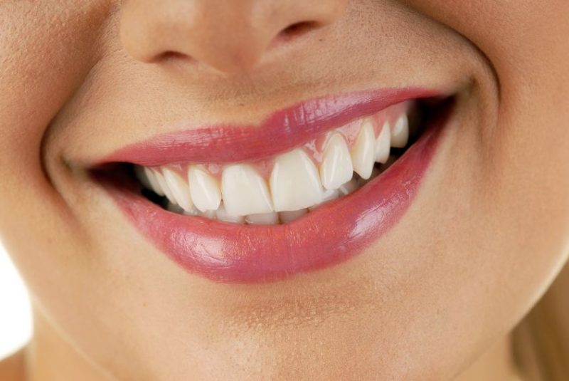 What to Know If You’re Getting Veneers